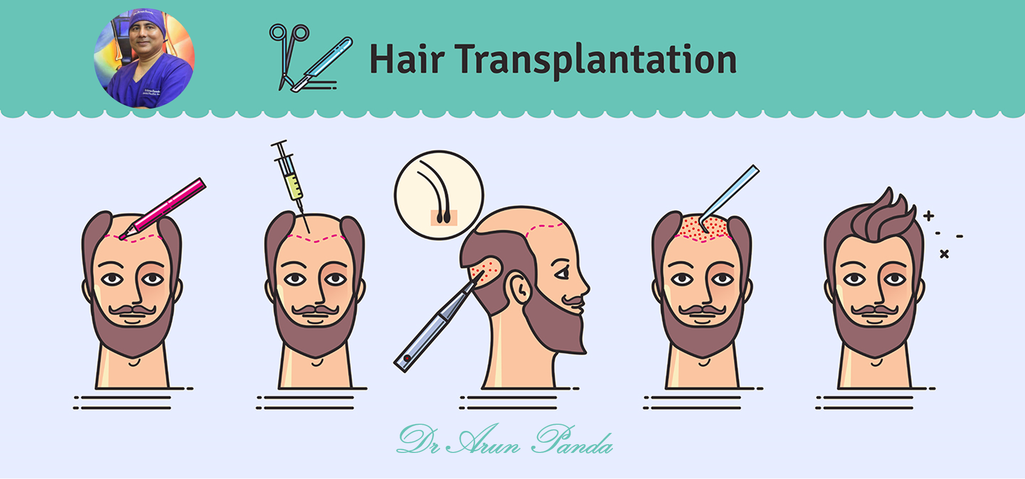 How Is Hair Transplant Performed In Navi Mumbai