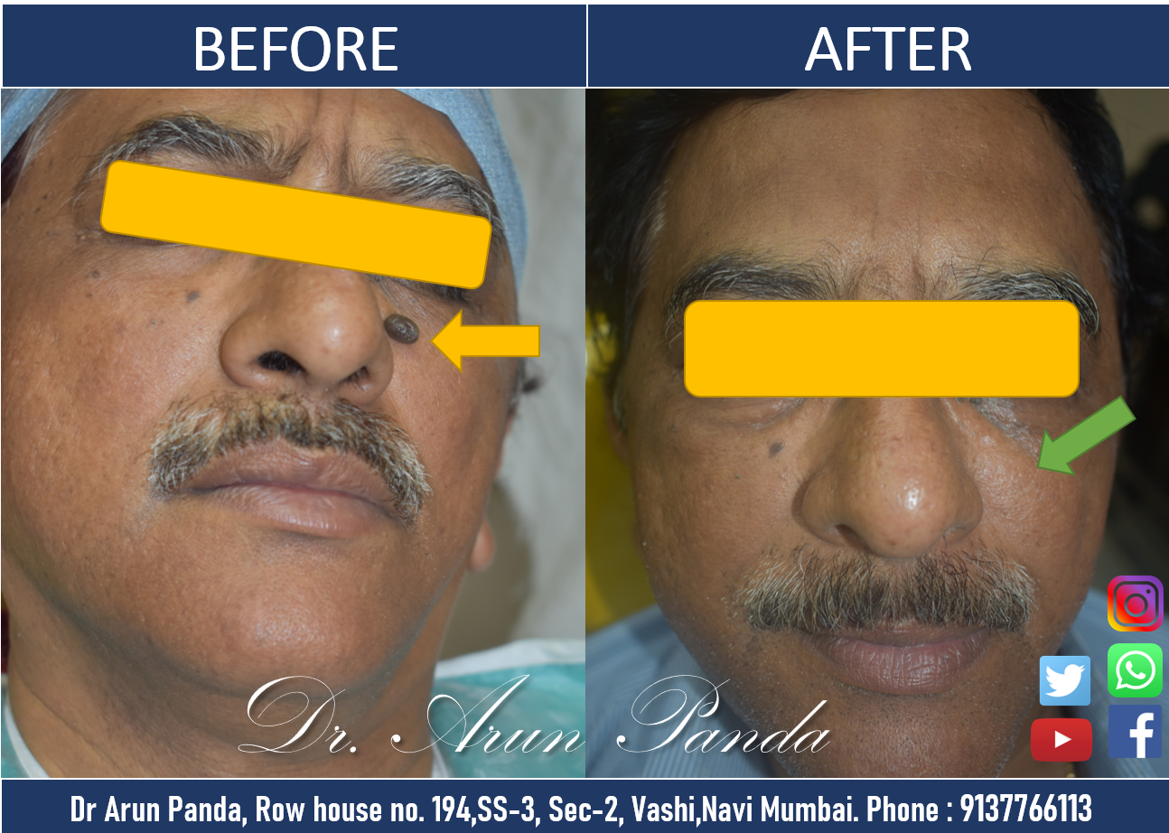 Mole Removal Treatment in Navi Mumbai by Certified Dermatologist