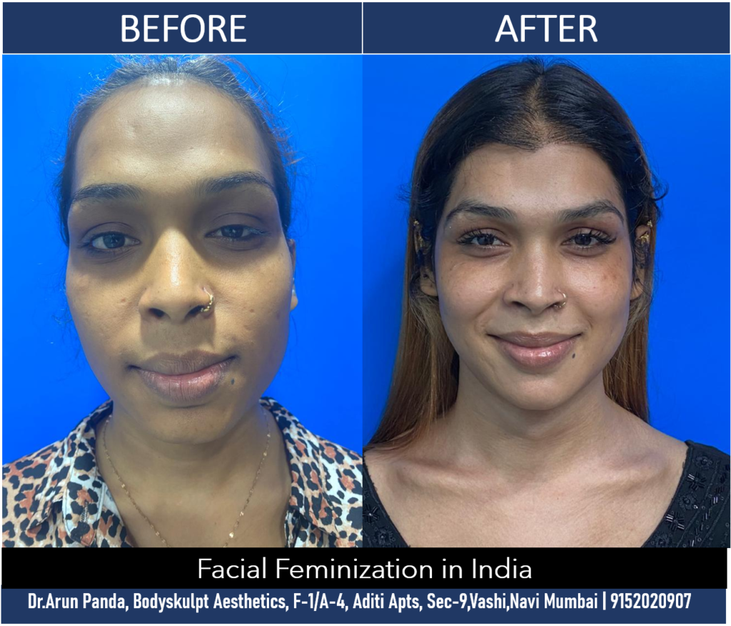 Cost of Facial Feminization Surgery in India | Price of Transgender Facial Surgery #ffs