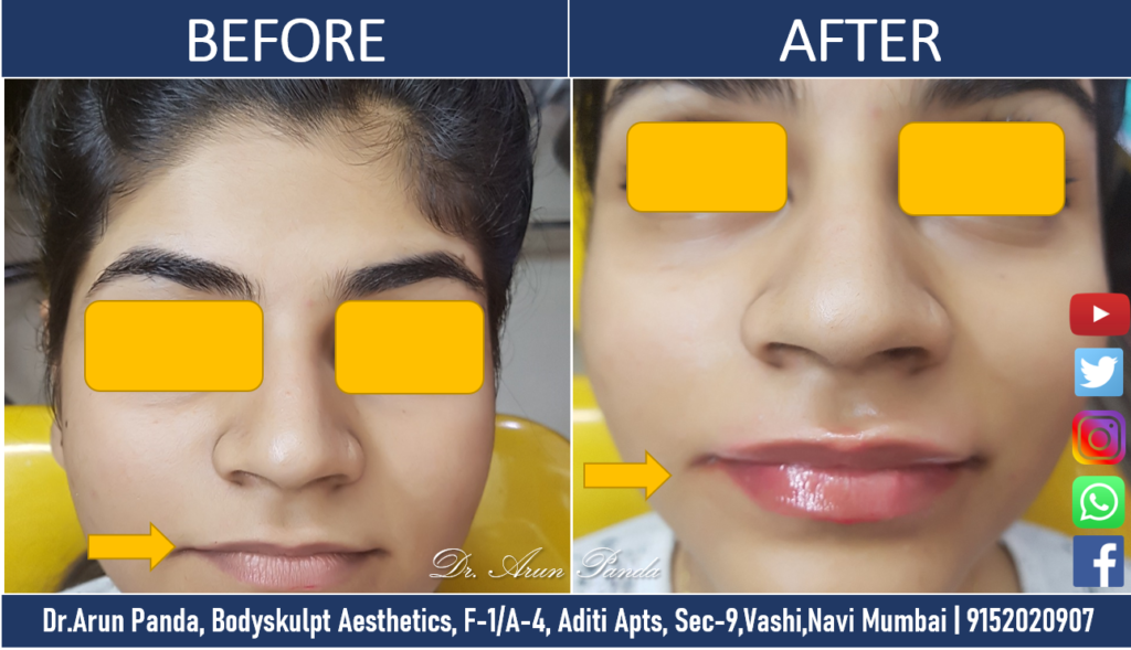 Lip Reshaping Treatment in Navi Mumbai – Cost, Procedure, Side Effects,  Learn everything about them.