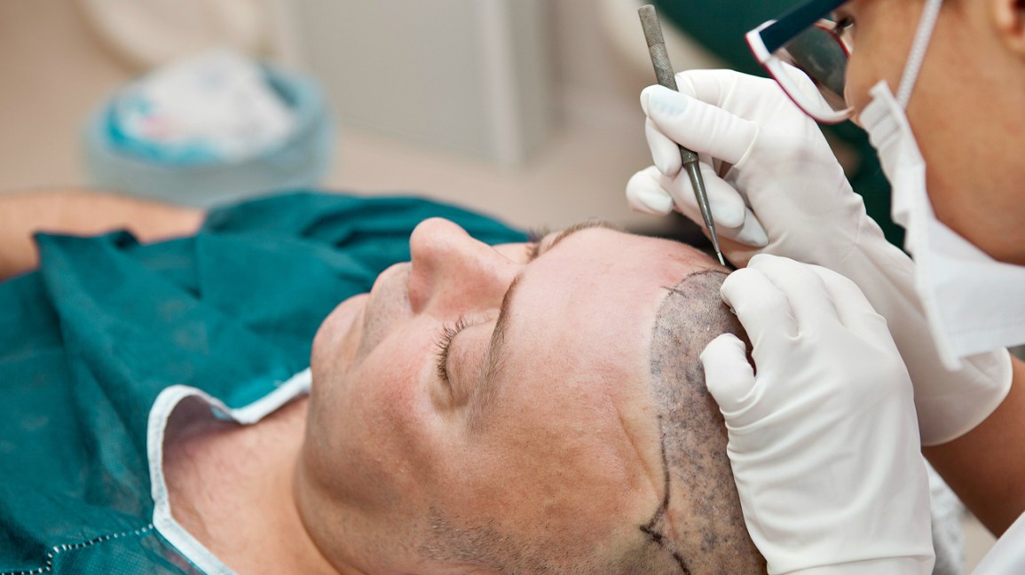How to Choose a Hair Transplant Specialist in Kuala Lumpur, Malaysia