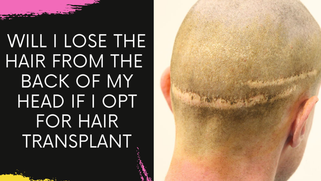 Will I Lose Hair from the Back of my Head if I opt for Hair Transplantation | Will it Grow back?