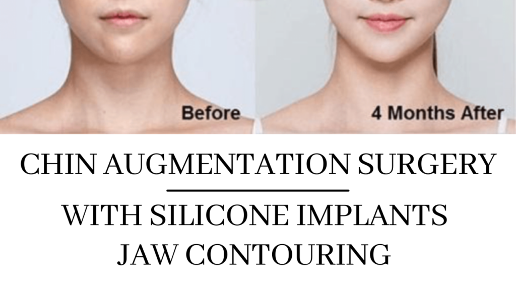 Chin Augmentation Surgery in Navi Mumbai by Facial Plastic Surgeon Dr. Arun Panda