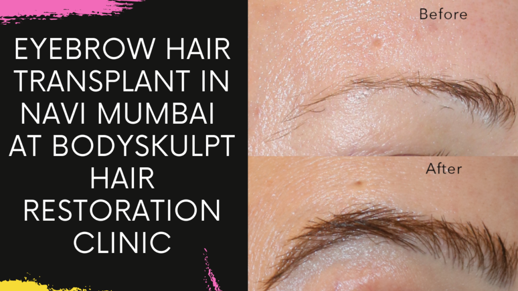Eyebrow Hair Transplant in Navi Mumbai at Bodyskulpt Hair Restoration Clinic