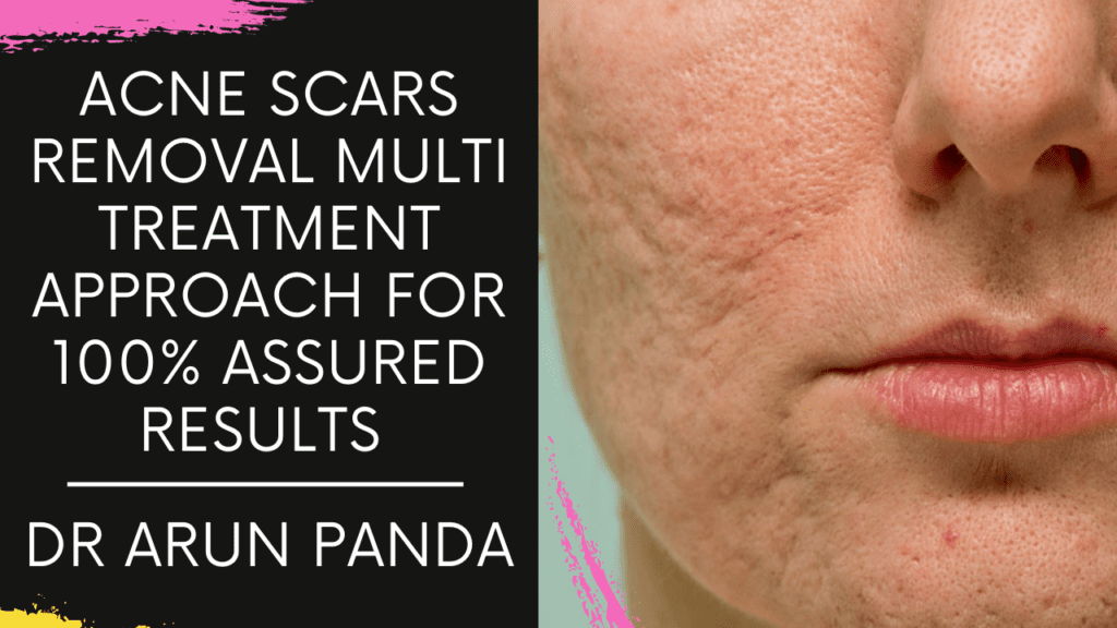 Best Acne Scar Treatment Navi Mumbai, Acne Scar Removal Treatment in Navi Mumbai