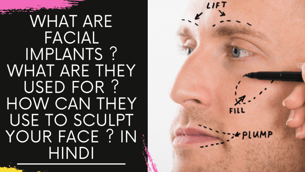 What are Facial Implants ? what are they used for ? How can they use to sculpt your face ?