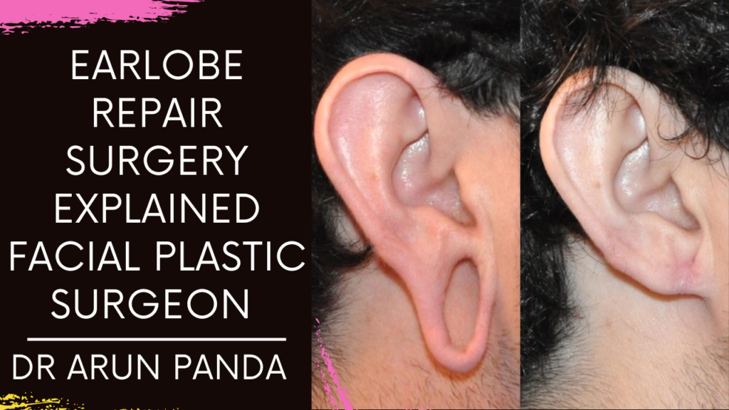 Learn about Earlobe Repair Surgery explained Facial Plastic Surgeon Dr. Arun Panda