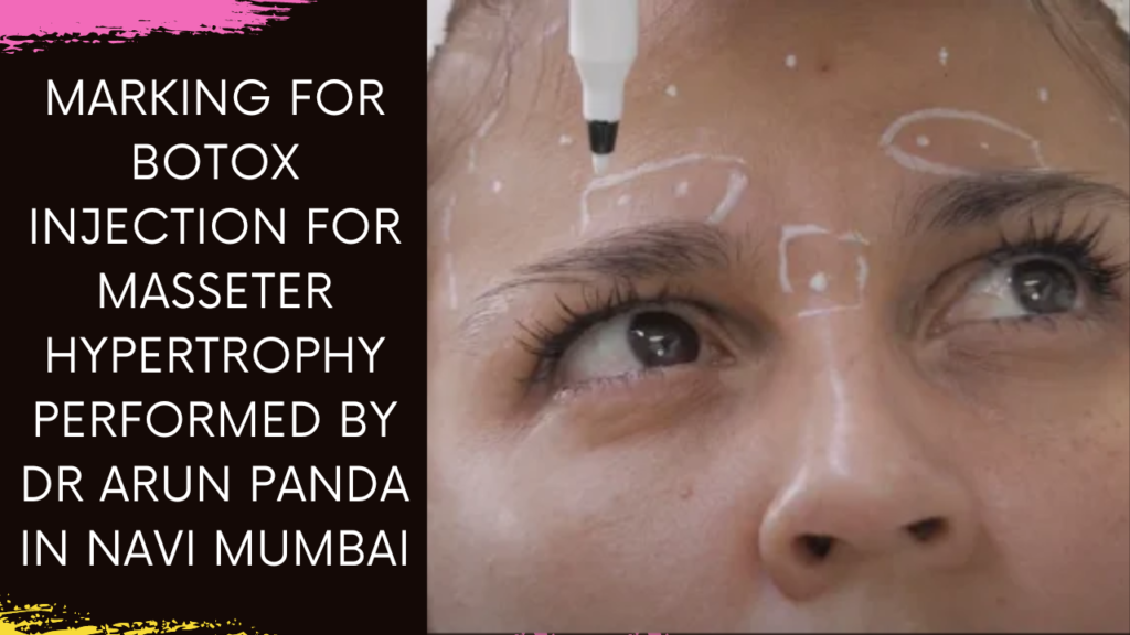 Mastering Masseter Hypertrophy: Botox Injection by Dr. Arun Panda in Navi Mumbai