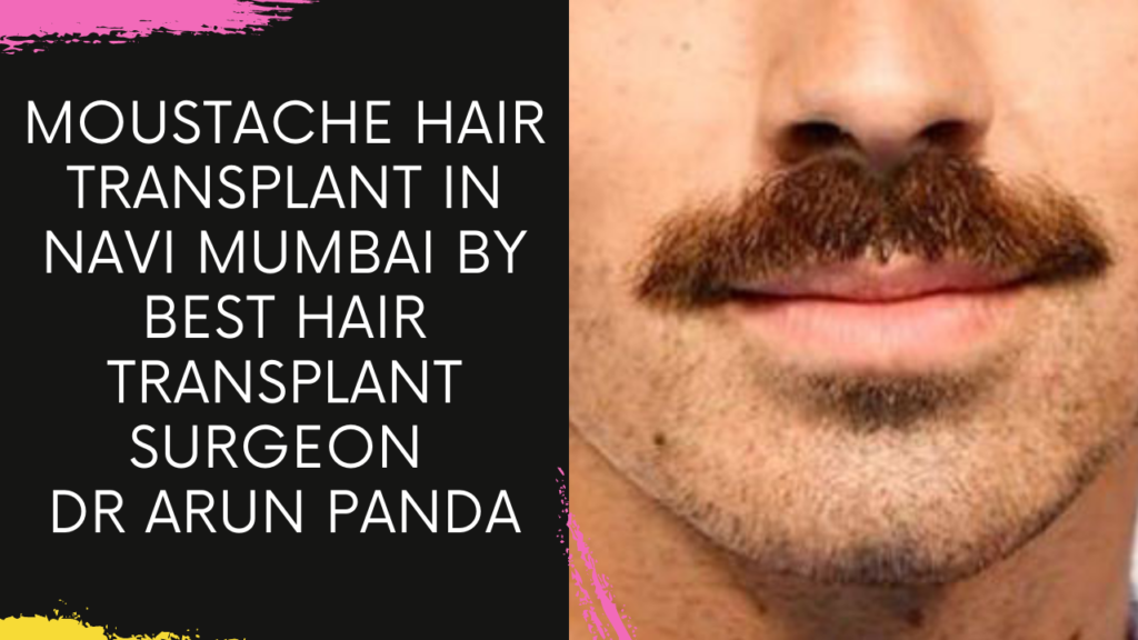 Moustache Transplant | What is Beard Balding? How are beard or mustache transplants performed?