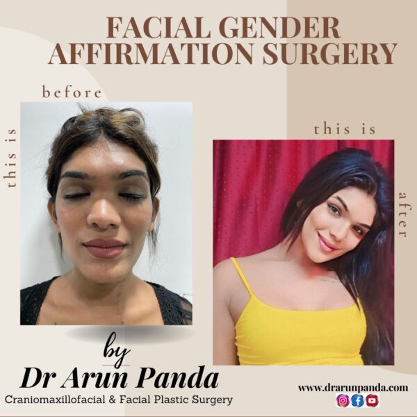 Facial Gender Affirmation Surgery In India 6316