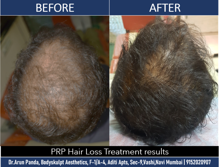 Visible Results with PRP Hair Loss Treatment
