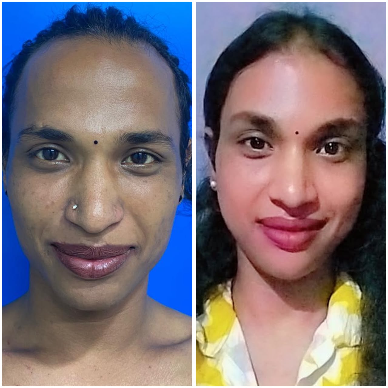 Before and after facial feminization surgery in India highlighting natural-looking facial contour enhancement and feminine facial features.
