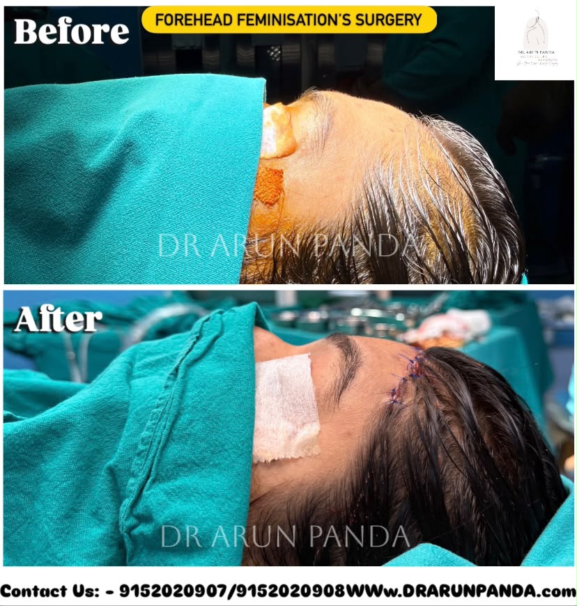 Facial feminization surgery in India before and after comparison showing softer facial contours and enhanced feminine facial features.