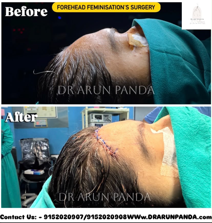 Results of facial feminization surgery in India showing before and after transformation of facial structure and contours.