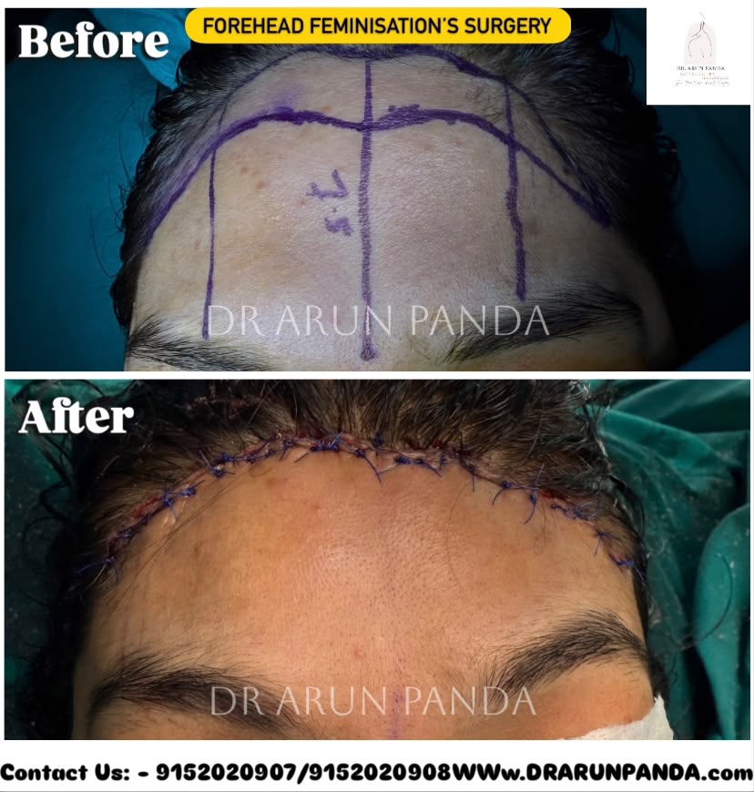 Before and after facial feminization surgery in India showing forehead, nose, jawline, and chin refinement for a more feminine facial appearance.