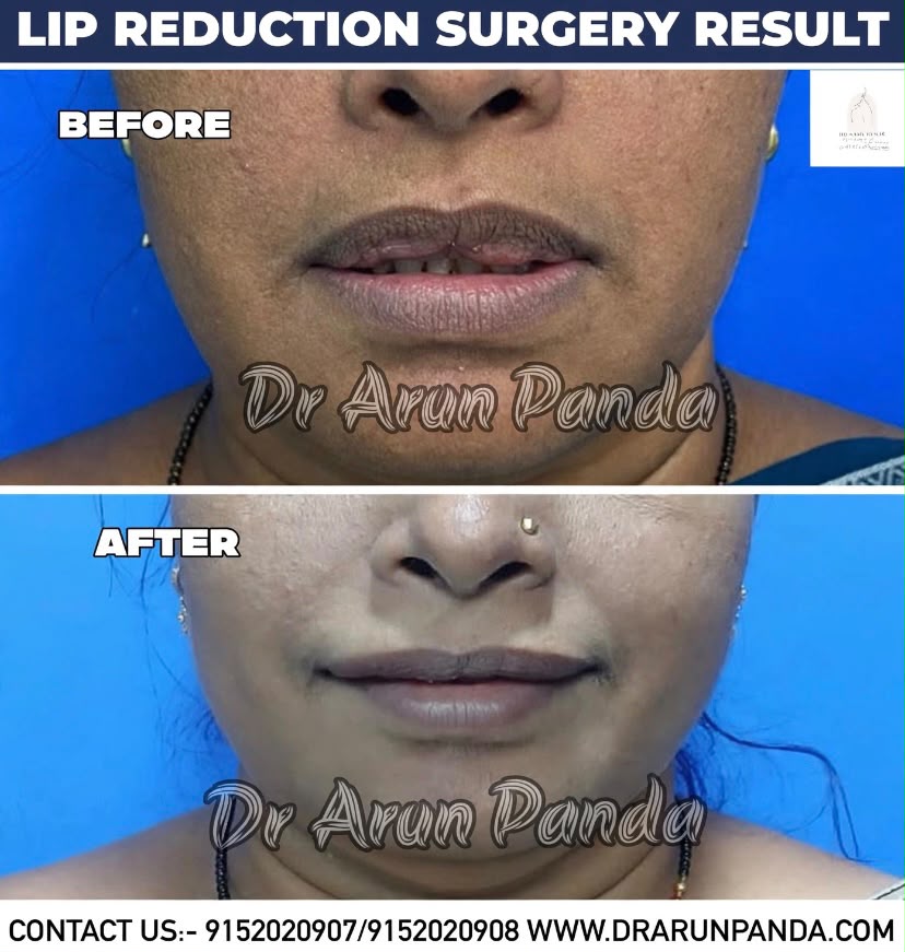 Lip reduction surgery before and after result showing a change in lip size and appearance