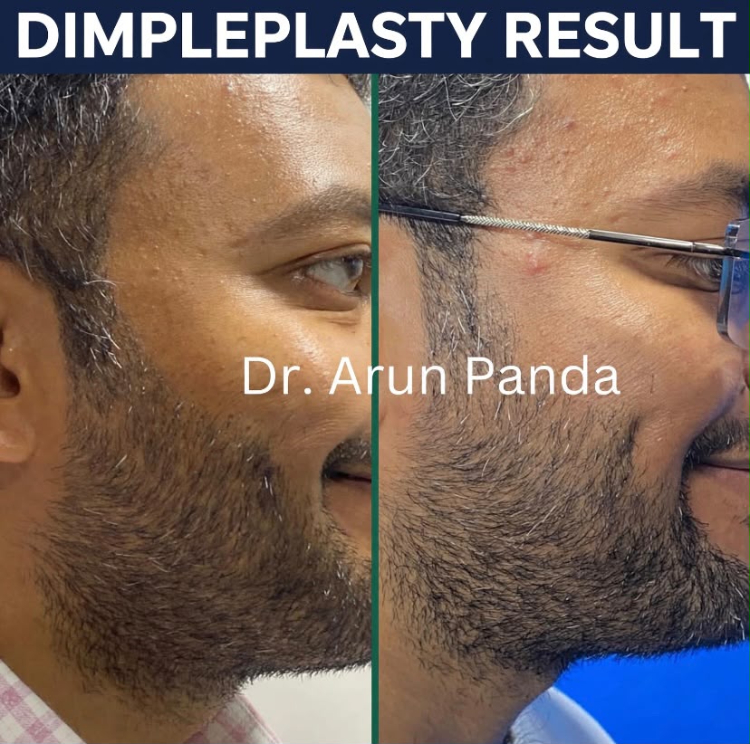 Before and after comparison showing the change in cheek appearance following dimpleplasty.