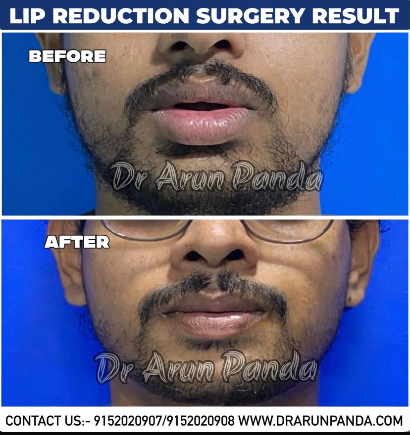 Lip reduction surgery before and after result showing a change in lip size and appearance