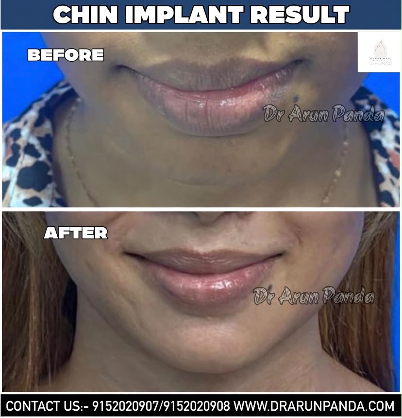 Before and after comparison showing facial profile and chin appearance following chin implant surgery.