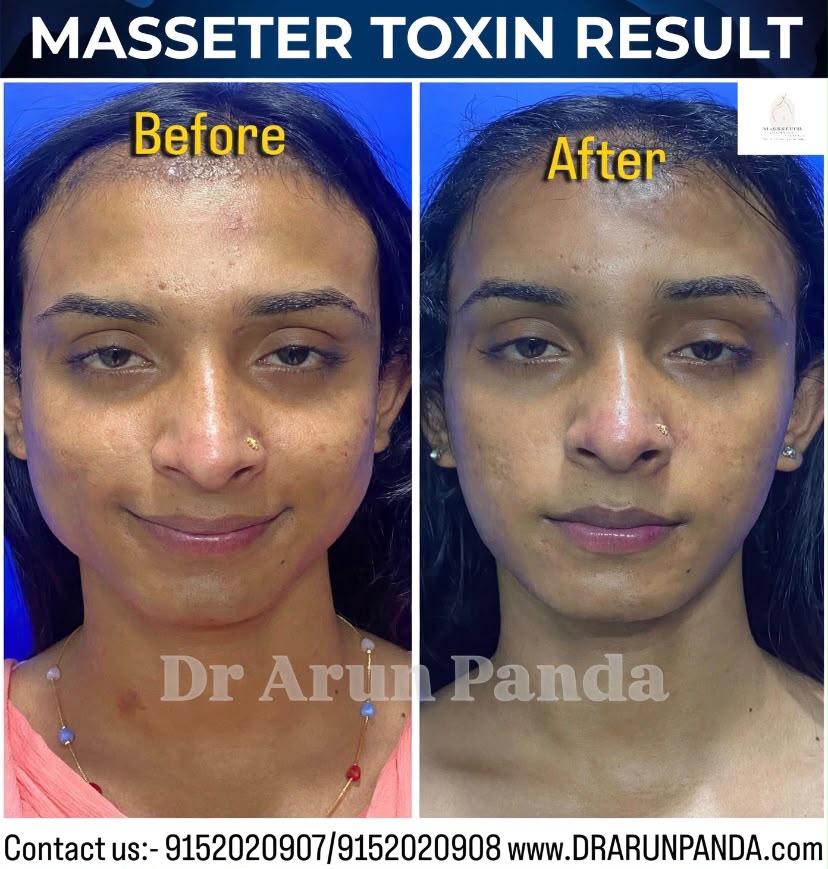 Before and after comparison showing facial contour changes following masseter toxin treatment.