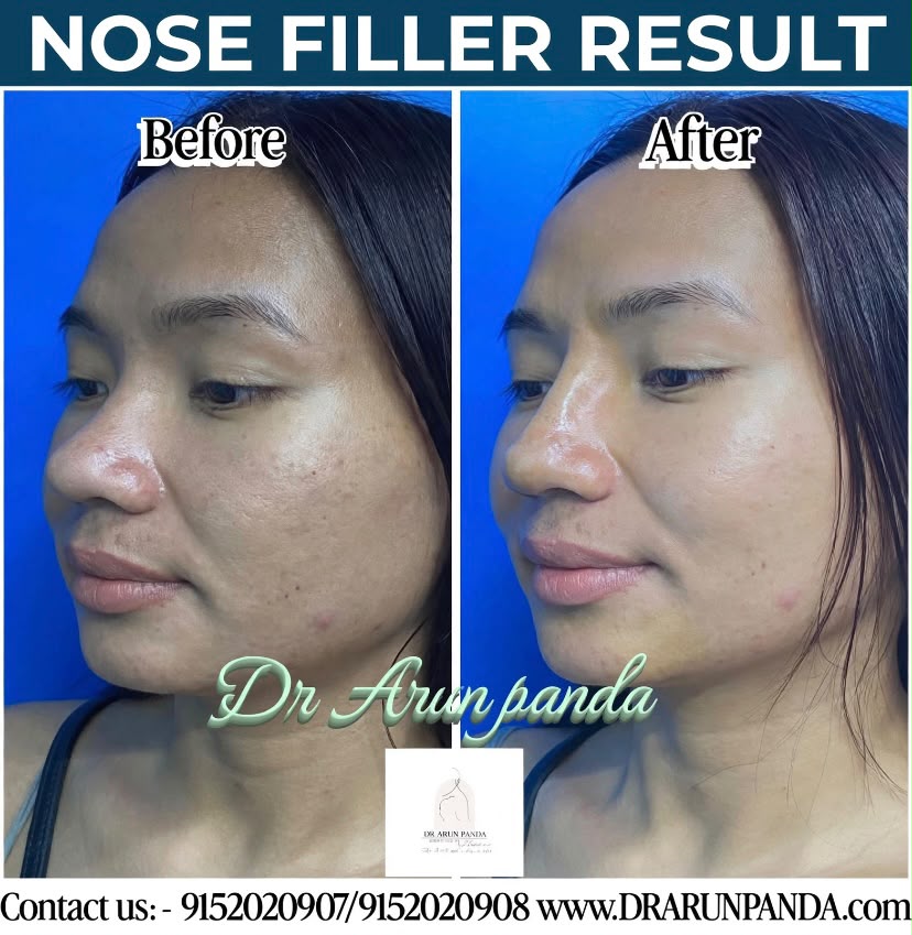 Nose filler before and after result showing an improved nose profile