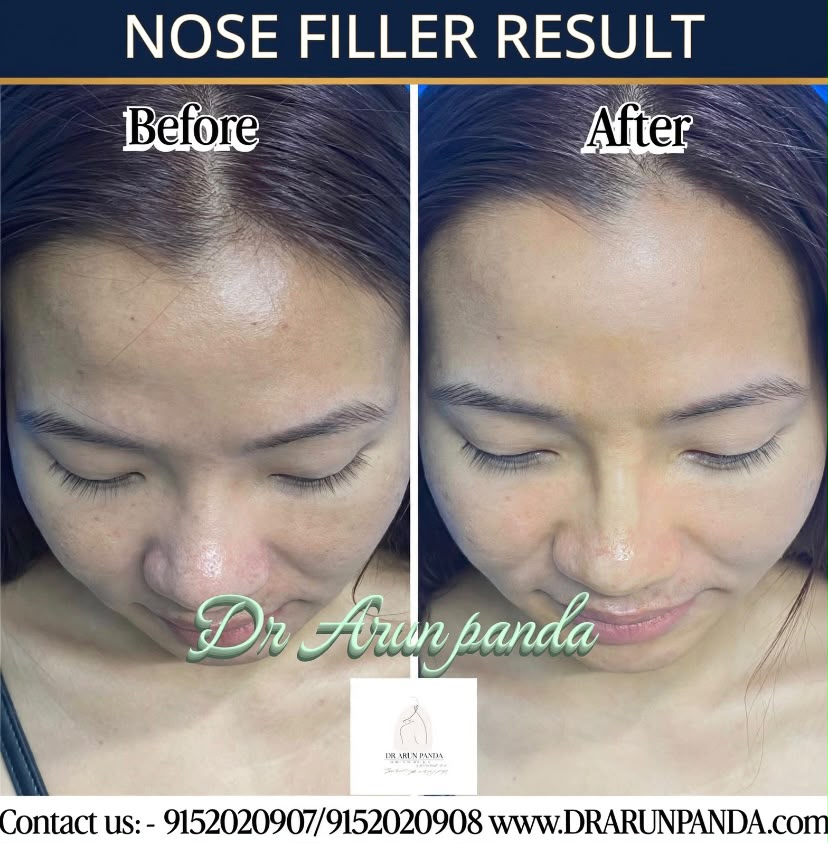 Nose filler before and after result showing an improved nose profile
