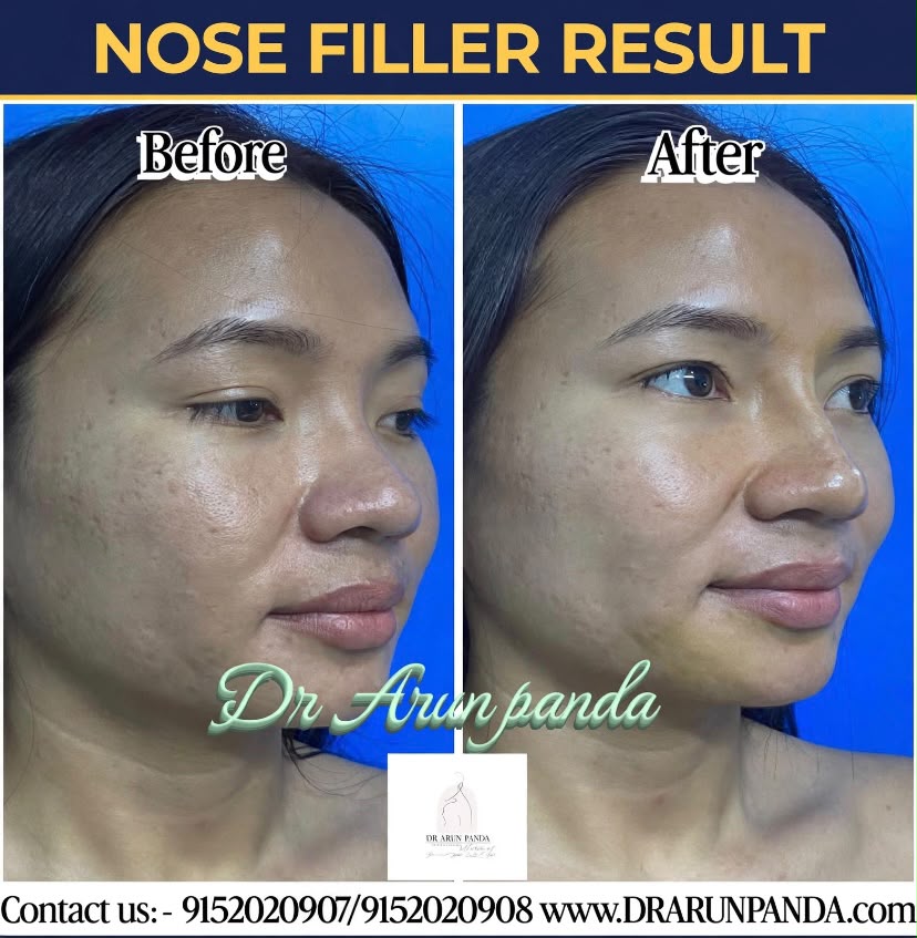 Nose filler before and after result showing an improved nose profile