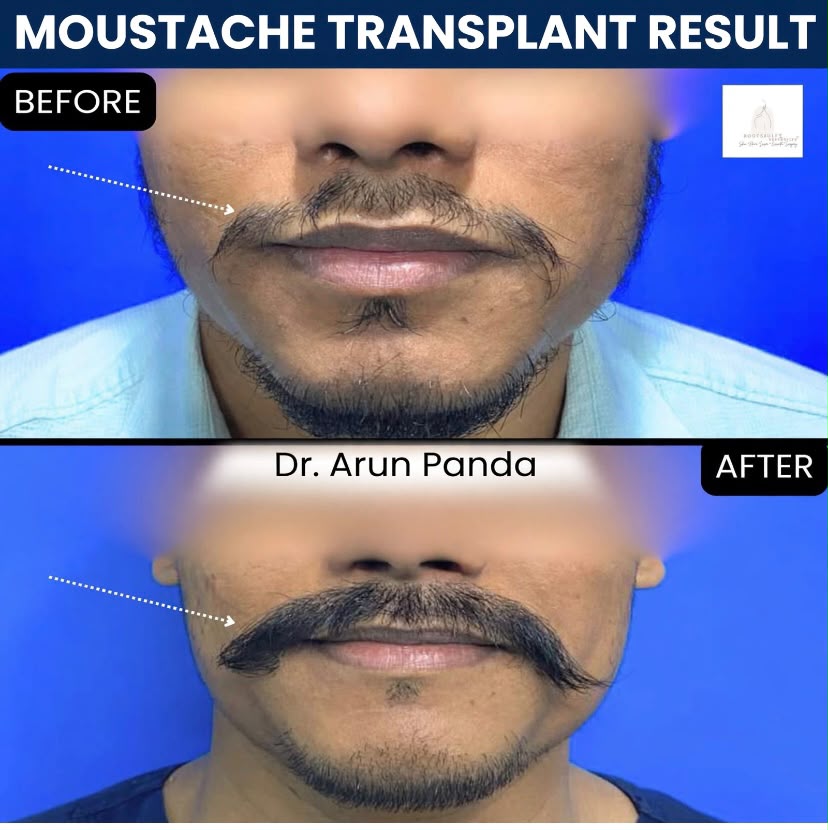Before and after comparison showing increased moustache density following moustache transplant surgery.