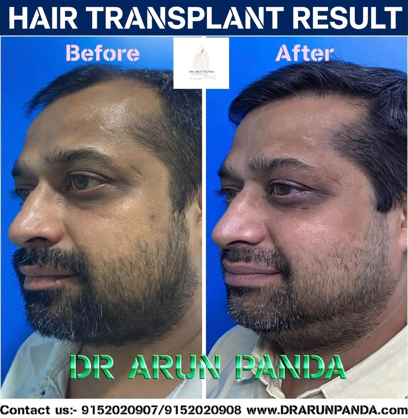 Hair transplant before and after result showing improved hairline and hair density