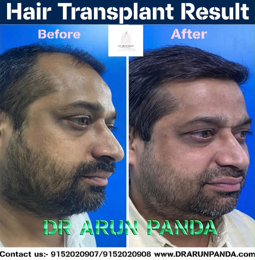 Hair transplant before and after result showing improved hairline and hair density
