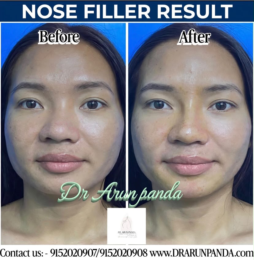 Nose filler before and after result showing an improved nose profile