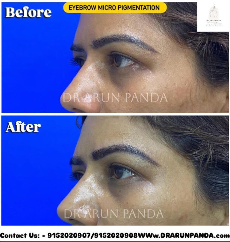 Before and after side-profile comparison showing improved eyebrow hair appearance following eyebrow hair restoration.
