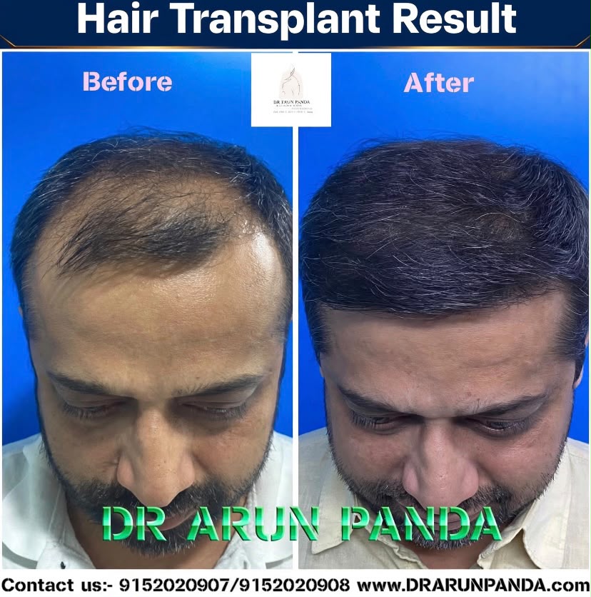 Hair transplant before and after result showing improved hairline and hair density