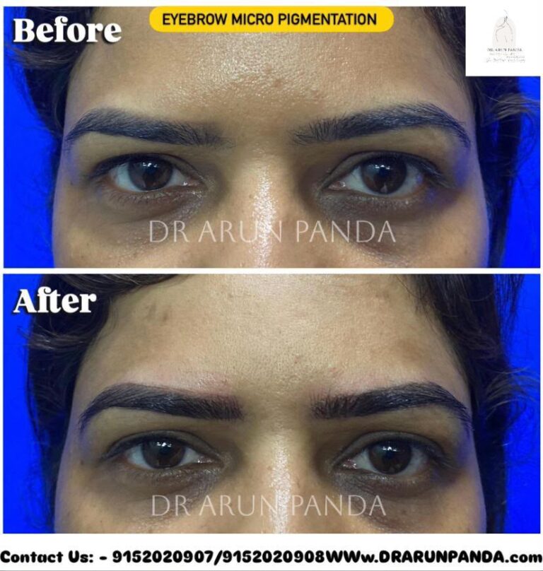 Before and after side-profile comparison showing improved eyebrow hair appearance following eyebrow hair restoration.