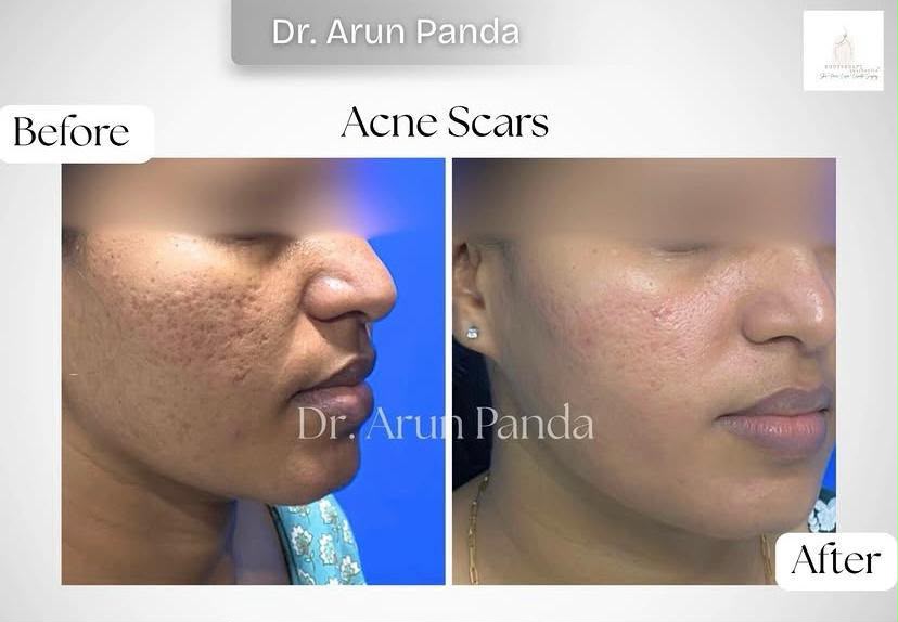 Acne scars before and after treatment showing improved skin texture