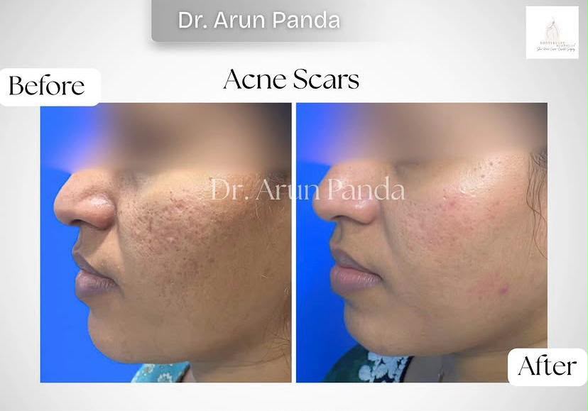 Acne scars before and after treatment showing improved skin texture