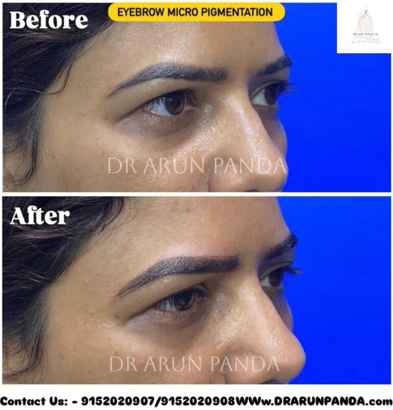 Before and after side-profile comparison showing improved eyebrow hair appearance following eyebrow hair restoration.