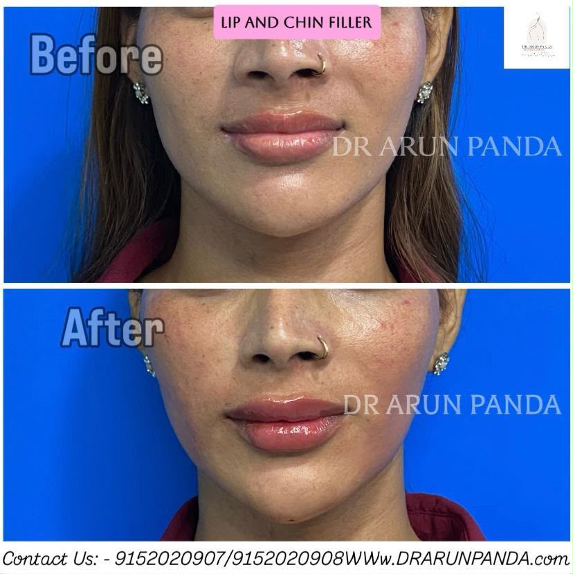 Before and after side-profile comparison showing changes in the lips and chin following lip and chin filler treatment.