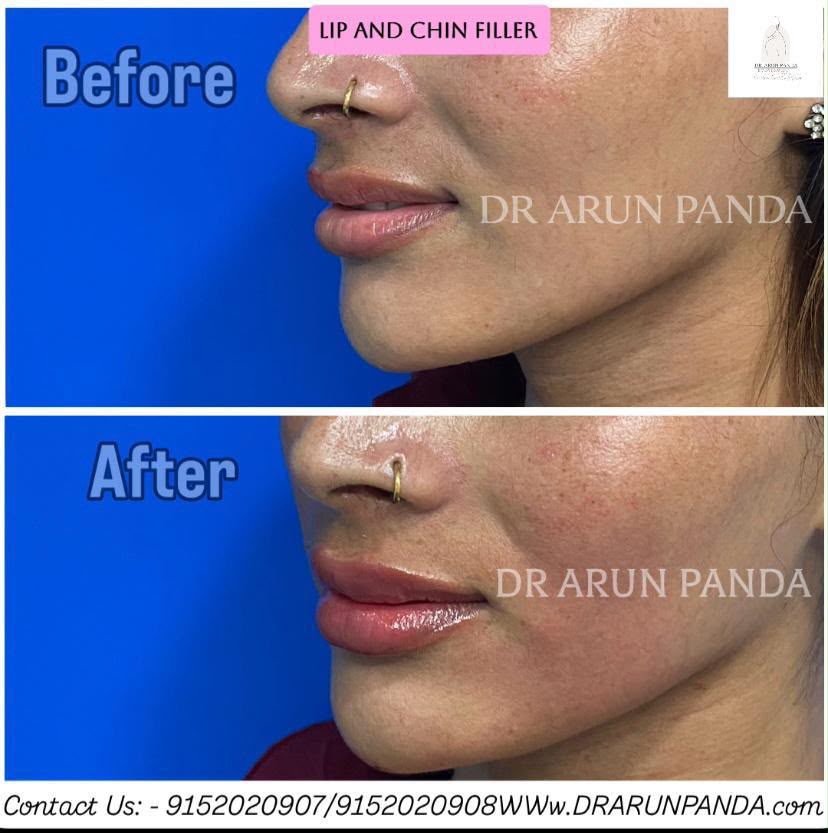 Before and after side-profile comparison showing changes in the lips and chin following lip and chin filler treatment.