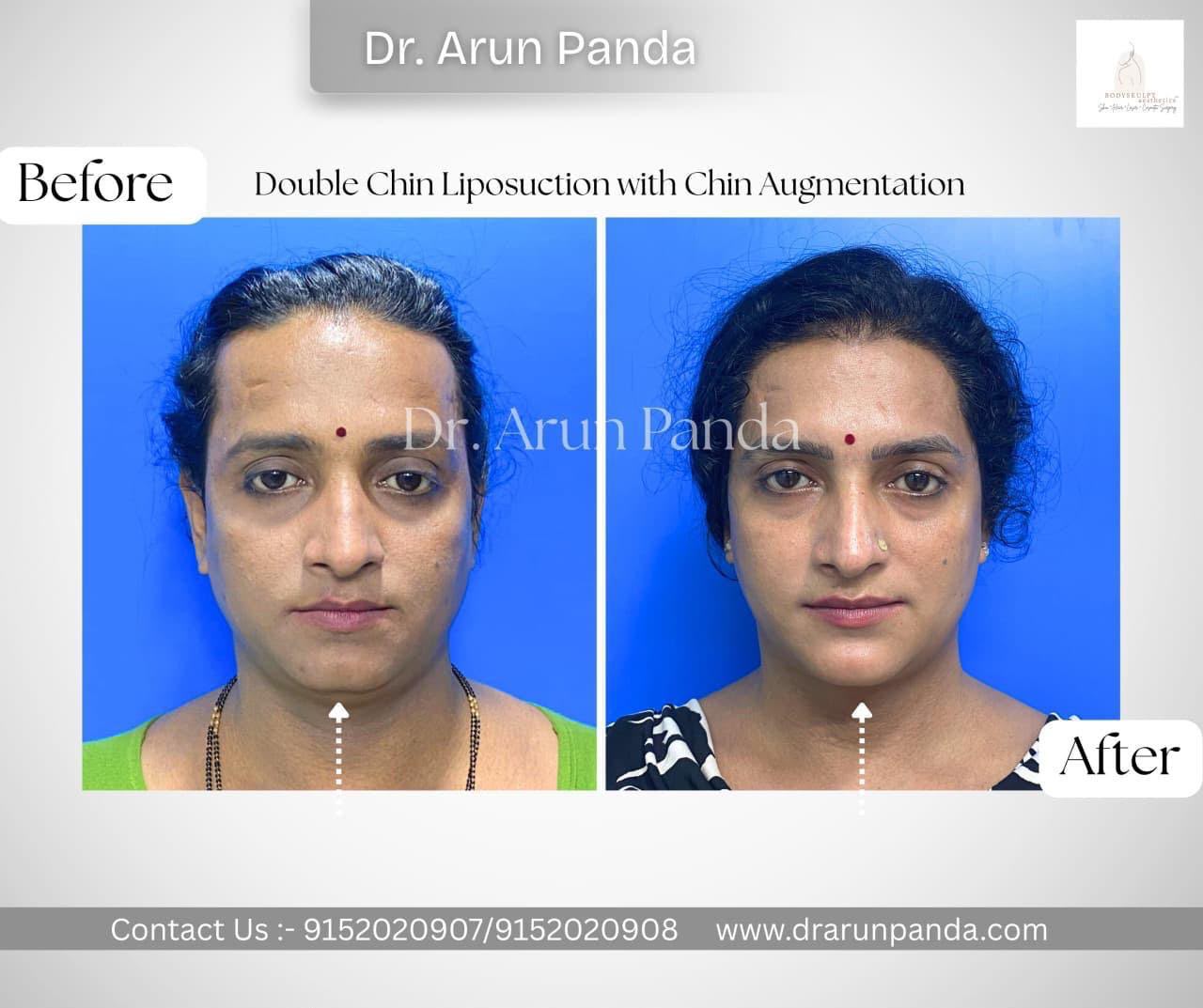 Before and after frontal comparison showing changes in chin projection and facial contour following double chin augmentation.