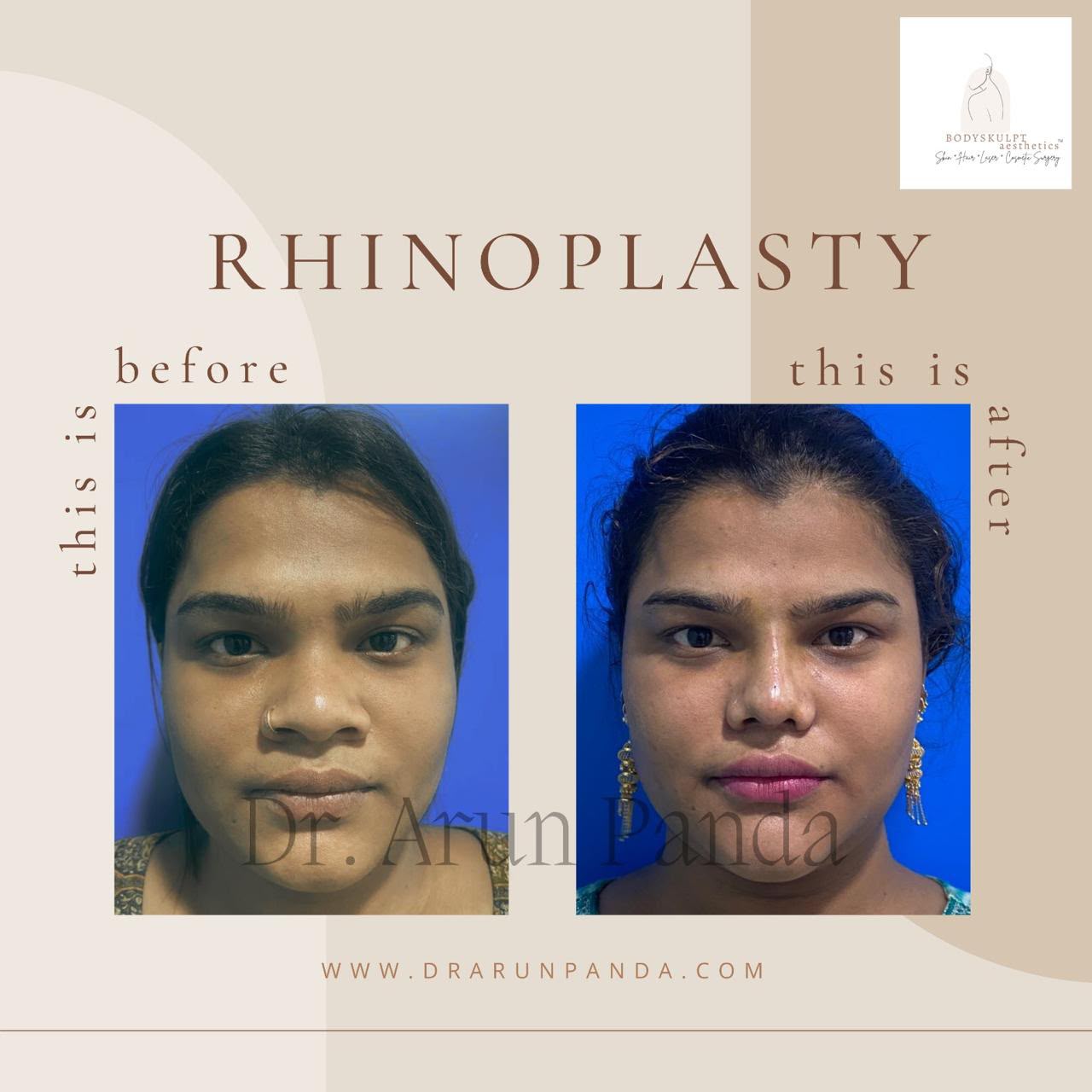 Before and after facial comparison showing changes in nose shape and facial profile following rhinoplasty.