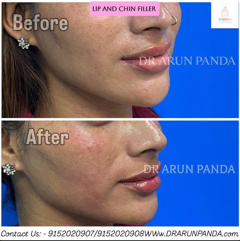 Before and after side-profile comparison showing changes in the lips and chin following lip and chin filler treatment.